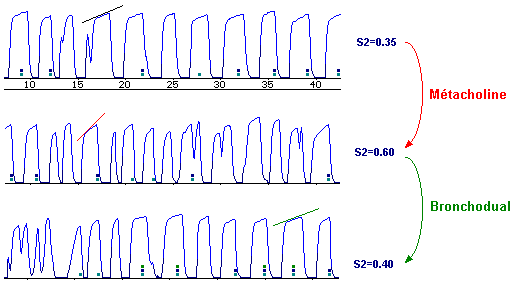 Bronchial provocative challenge using metacholine in a children