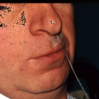 Fixation du cath&eacute;ter